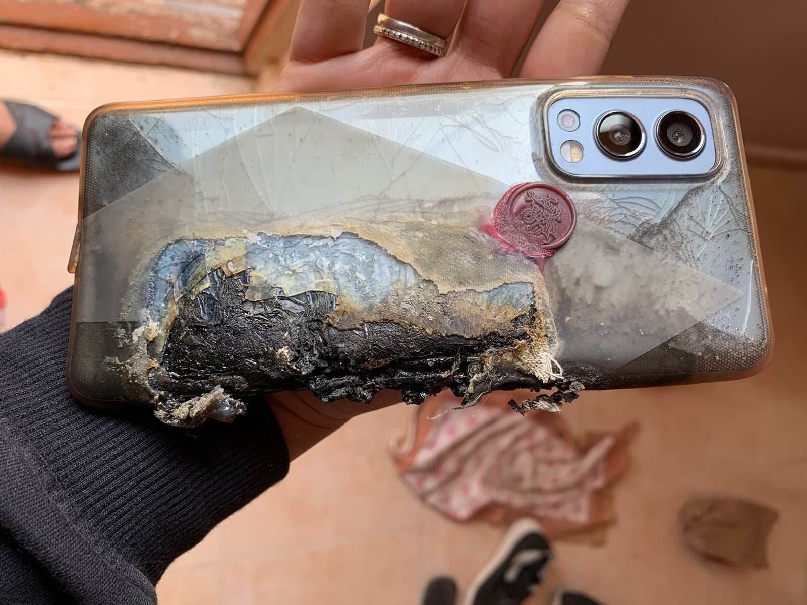 Смартфон OnePlus оставил на пользователе жуткие ожоги